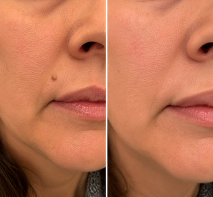 ✨✨✨ PURESHADE® 2v1 mikrojehličková + hydrokoloidní náplast🍀 | Pomáhá odstraňovat vystouplá znaménka, akné, ploché bradavice a kožní výrůstky | Pomáhá zjemnit vrásky, jizvy a nedokonalosti pleti | Diskrétní neviditelná náplast pro obličej i tělo