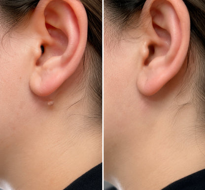 ✨✨✨ PURESHADE® 2v1 mikrojehličková + hydrokoloidní náplast🍀 | Pomáhá odstraňovat vystouplá znaménka, akné, ploché bradavice a kožní výrůstky | Pomáhá zjemnit vrásky, jizvy a nedokonalosti pleti | Diskrétní neviditelná náplast pro obličej i tělo