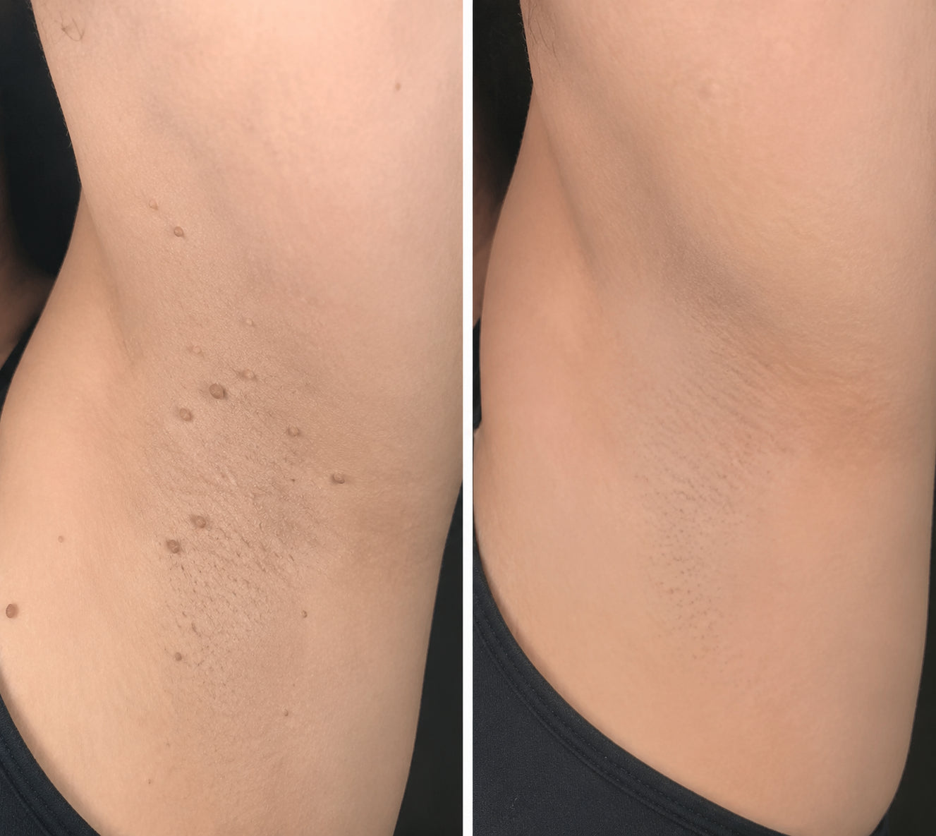 ✨✨✨ PURESHADE® 2v1 mikrojehličková + hydrokoloidní náplast🍀 | Pomáhá odstraňovat vystouplá znaménka, akné, ploché bradavice a kožní výrůstky | Pomáhá zjemnit vrásky, jizvy a nedokonalosti pleti | Diskrétní neviditelná náplast pro obličej i tělo