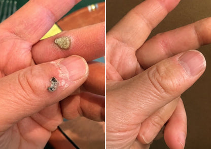 ✨✨✨ PURESHADE® 2v1 mikrojehličková + hydrokoloidní náplast🍀 | Pomáhá odstraňovat vystouplá znaménka, akné, ploché bradavice a kožní výrůstky | Pomáhá zjemnit vrásky, jizvy a nedokonalosti pleti | Diskrétní neviditelná náplast pro obličej i tělo