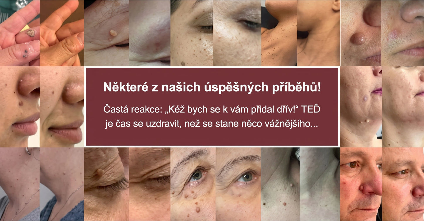 ✨✨✨ PURESHADE® 2v1 mikrojehličková + hydrokoloidní náplast🍀 | Pomáhá odstraňovat vystouplá znaménka, akné, ploché bradavice a kožní výrůstky | Pomáhá zjemnit vrásky, jizvy a nedokonalosti pleti | Diskrétní neviditelná náplast pro obličej i tělo
