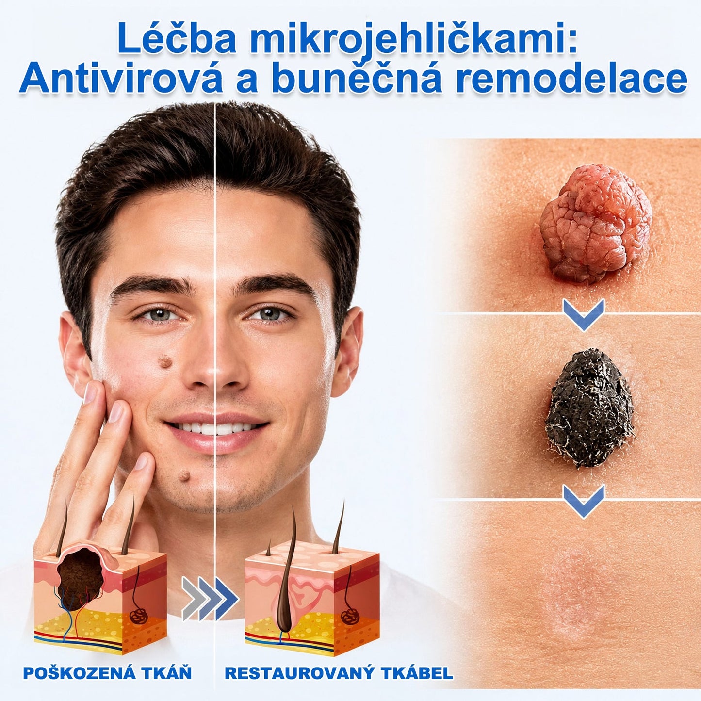 ✨✨✨ PURESHADE® 2v1 mikrojehličková + hydrokoloidní náplast🍀 | Pomáhá odstraňovat vystouplá znaménka, akné, ploché bradavice a kožní výrůstky | Pomáhá zjemnit vrásky, jizvy a nedokonalosti pleti | Diskrétní neviditelná náplast pro obličej i tělo